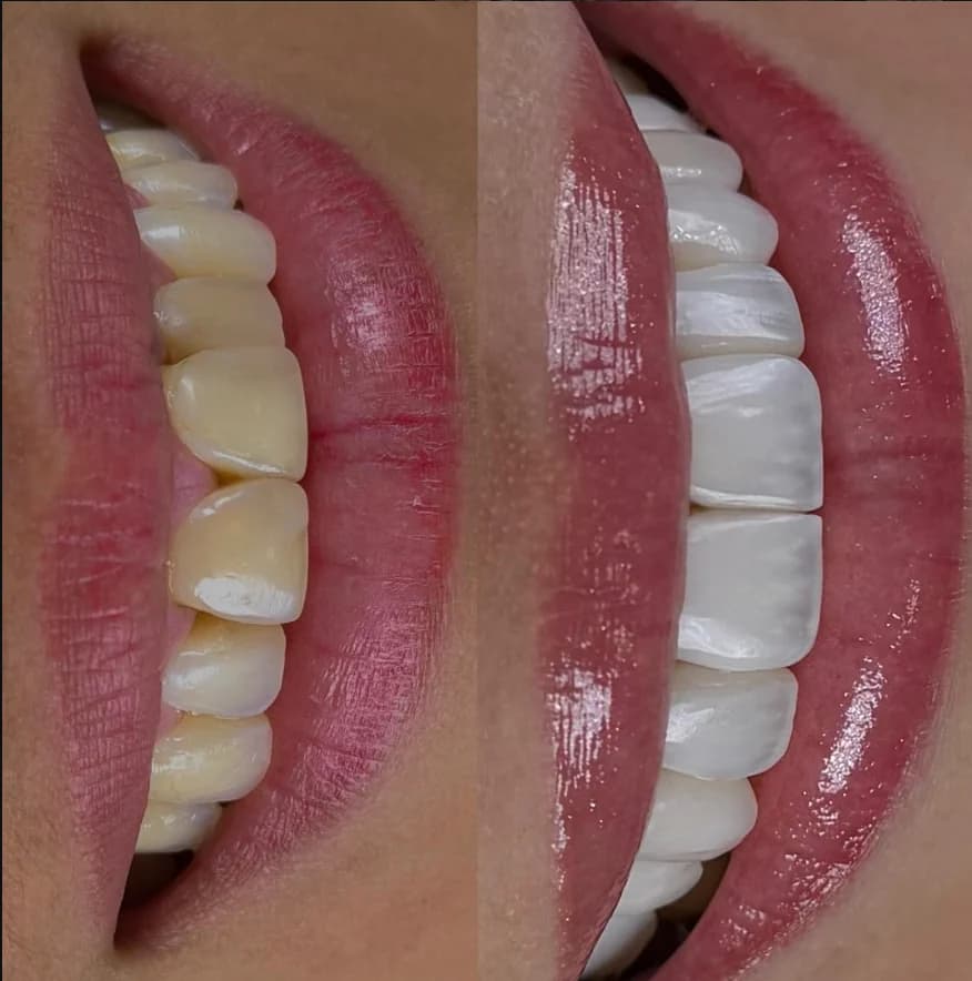 Antes e depois real de um sorriso, em vista lateral