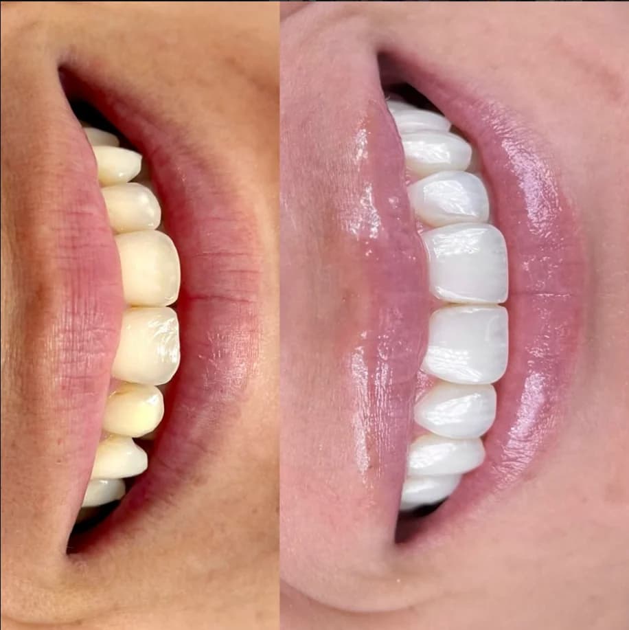 Antes e depois real de outro sorriso, em vista lateral