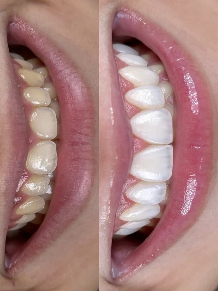 Comparação de antes e depois do sorriso — foto 1