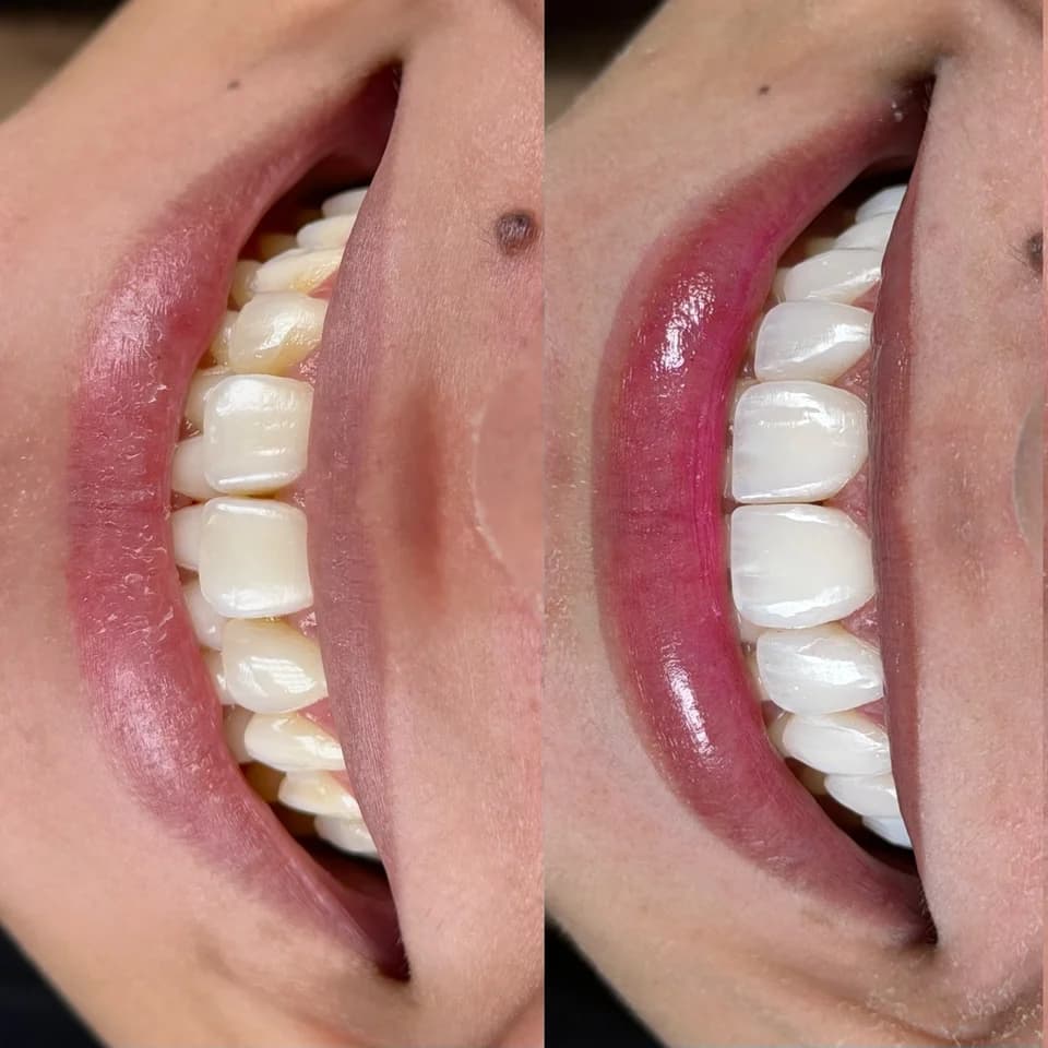 Comparação de antes e depois do sorriso — foto 4