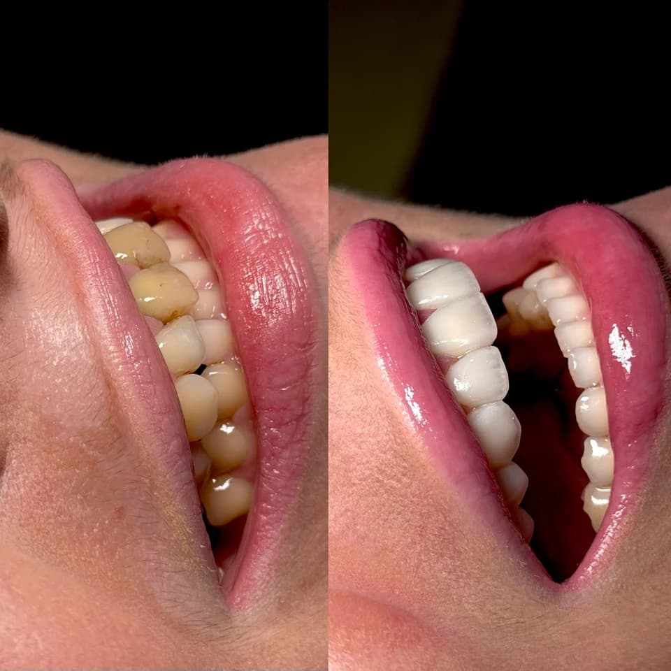 Comparação de antes e depois do sorriso — foto 5